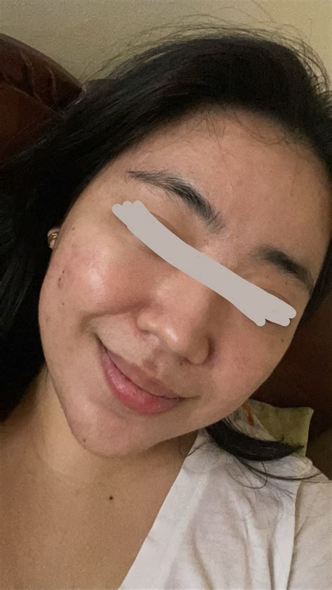 Pinays With Acne.